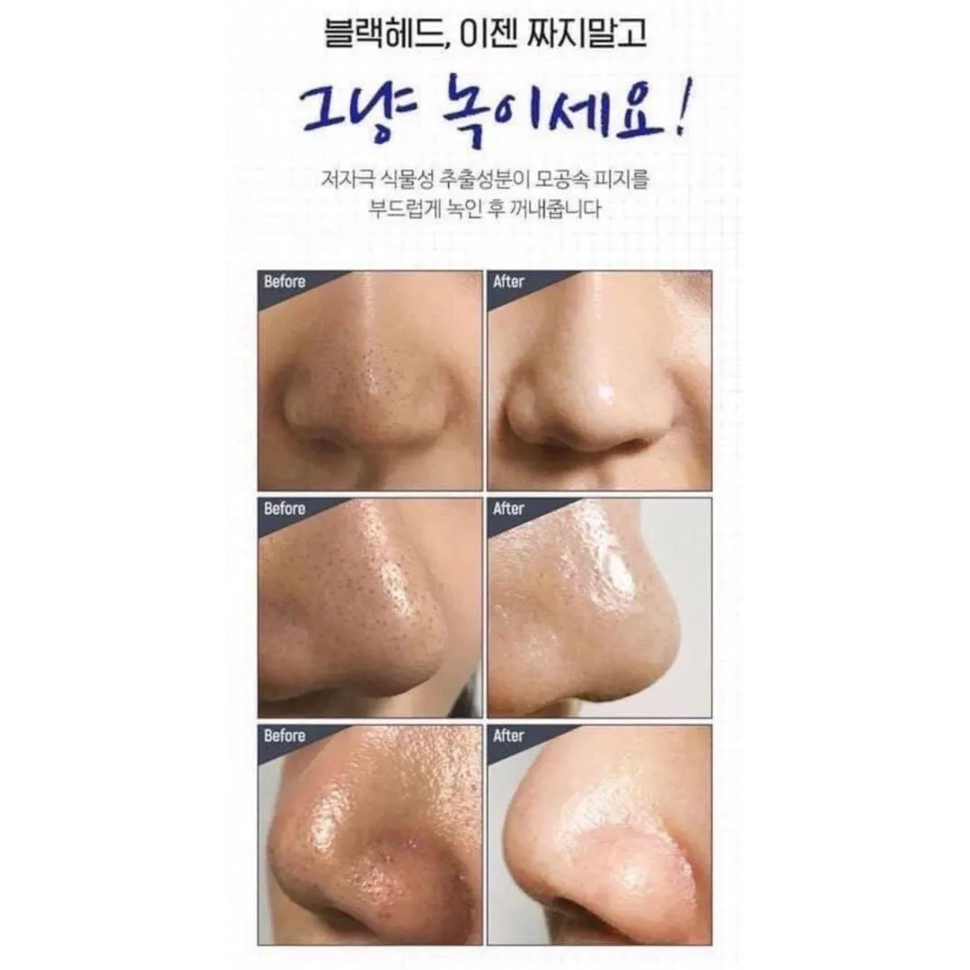 ‼️4折‼️ONE DAY'S YOU No More Blackhead Pore Clearing Duo  黑頭導出液 100ml【全網現貨】